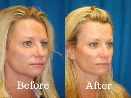 Before and picture pf a patient that had a rhinoplasty procedure at Integrated ENT.