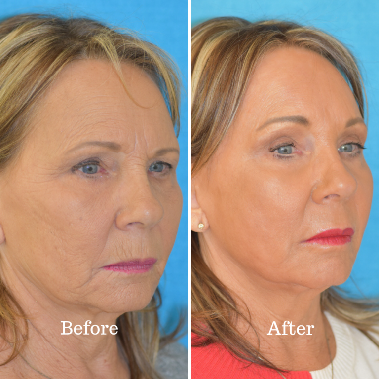 A before and after photo of a patient that had a brow lift and laser skin resurfacing at Integrated ENT.