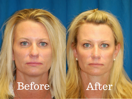Before and picture of a patient that had a rhinoplasty procedure at Integrated ENT.