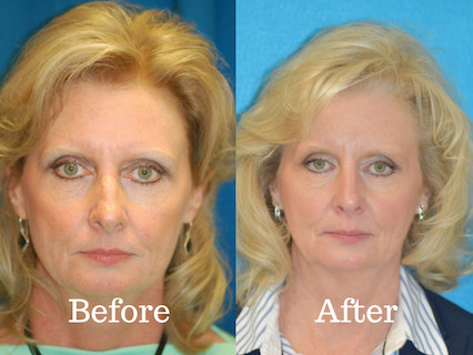 Before and picture of a patient that had a rhinoplasty procedure at Integrated ENT.