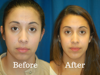 Before and after picture of a patient that had a chin implant procedure at Integrated ENT.