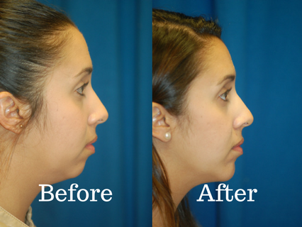 Before and after picture of a patient that had a chin implant procedure at Integrated ENT.