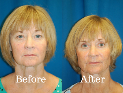 Before and after photo of a patient that had an upper blepharoplasty procedure completed at Integrated ENT.