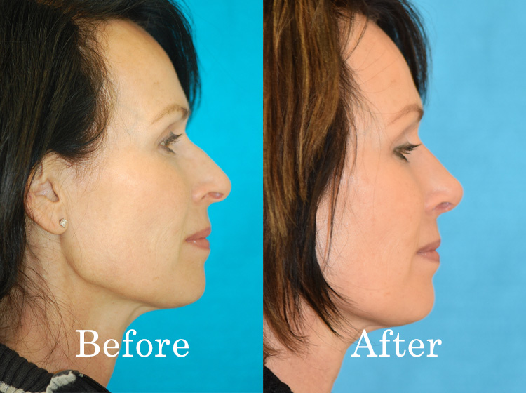 Before and after rhinoplasty - Integrated ENT