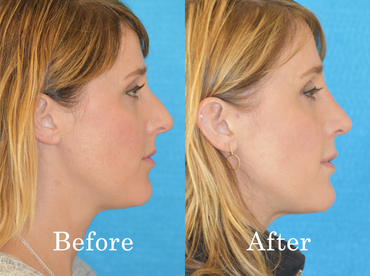 Before and after rhinoplasty - Integrated ENT