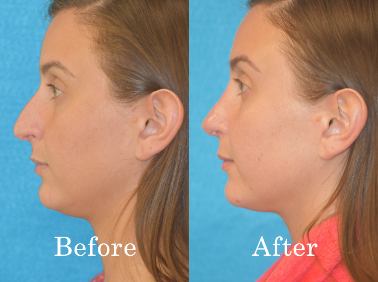 Before and after rhinoplasty side view