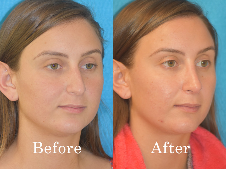 before and after rhinoplasty front view