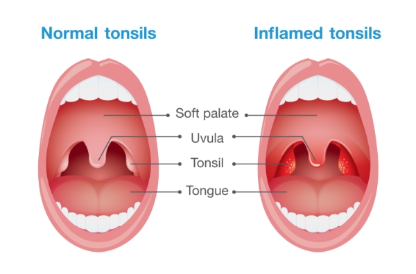 IntegratedENT - Tonsils