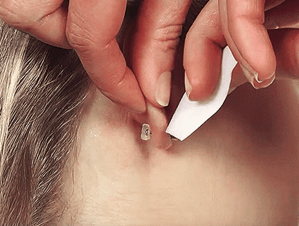IntegratedENT - Medical Ear Piercing